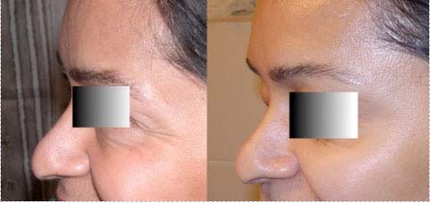 Botulinum toxin for wrinkles