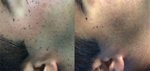 Moles Removal
