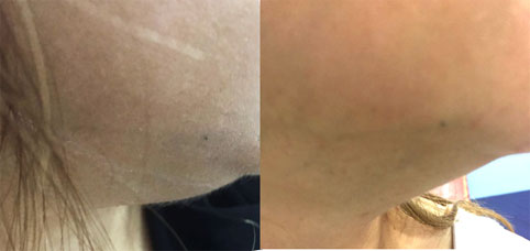 Double chin and localised fat reduction