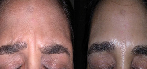 Botulinum toxin for wrinkles