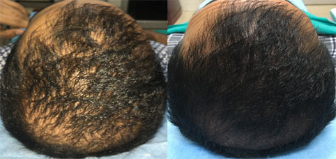 Platelet Rich Plasma