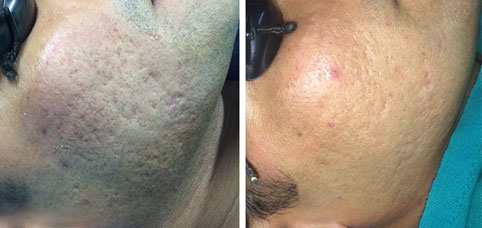 Acne scarring