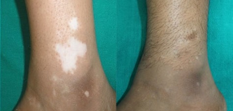Vitiligo