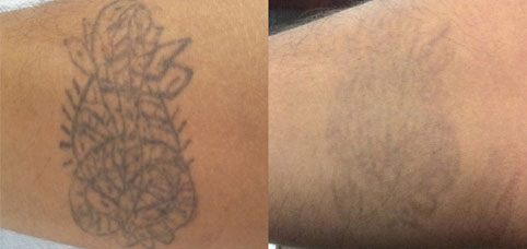 Laser tattoo removal
