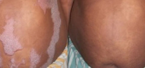 Psoriasis