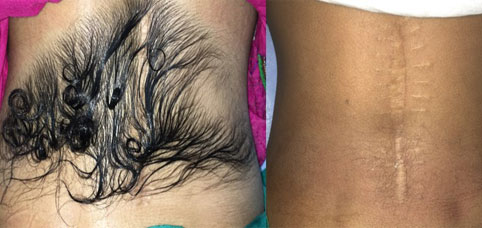 Hair removal as medical treatment