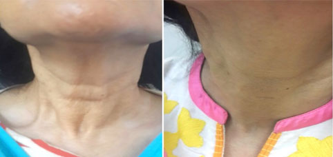 Neck Rejuvenation