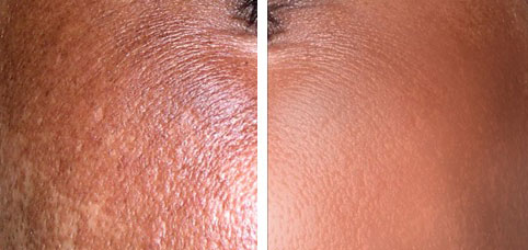 Chemical peels