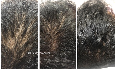 Botulinum toxin