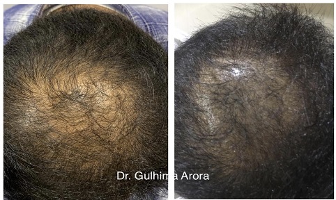 Botulinum toxin